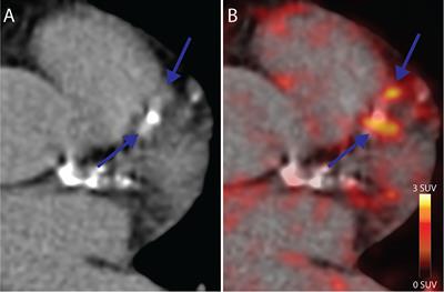 Effect of 26 Weeks of Liraglutide Treatment on Coronary Artery Inflammation in Type 2 Diabetes Quantified by [64Cu]Cu-DOTATATE PET/CT: Results from the LIRAFLAME Trial